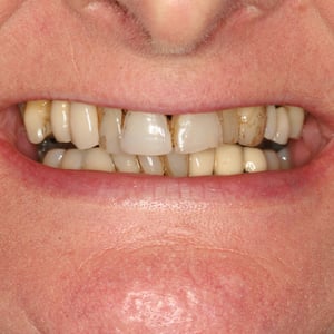 Mr B's veneers were chipped and stained