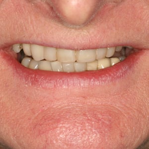 Cosmetic bonding at Elmsleigh House improved Mrs B's teeth and smile
