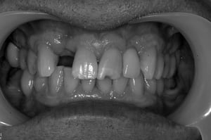 Mr Roger Wane Dental implant smile