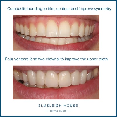 Composite bonding versus veneers - key differences at Elmsleigh House Dental Clinic