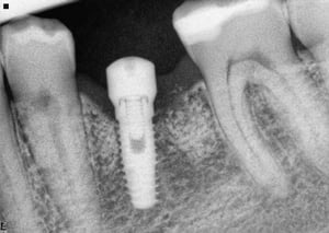 ID implant abutment