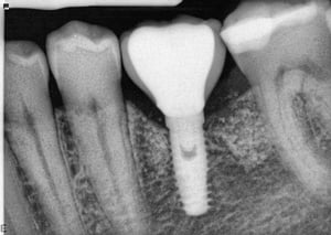 ID implant crown x-ray
