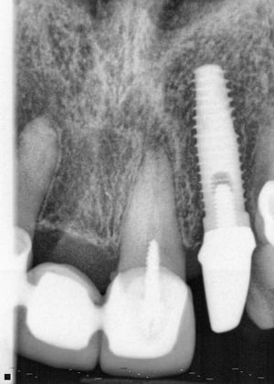 JR implant x-ray and post 11.2.20