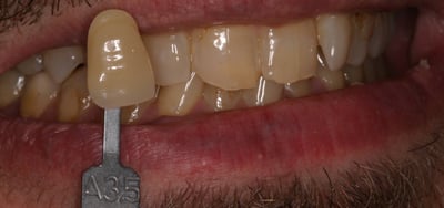 Mr S whitening 6-12-19