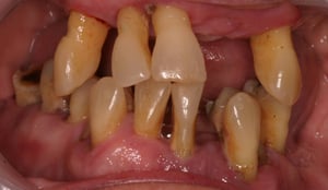 Mrs W remaining teeth