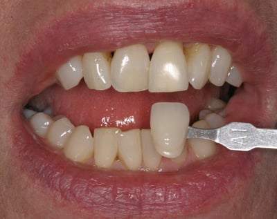 Ms C 26-2-18 whitening