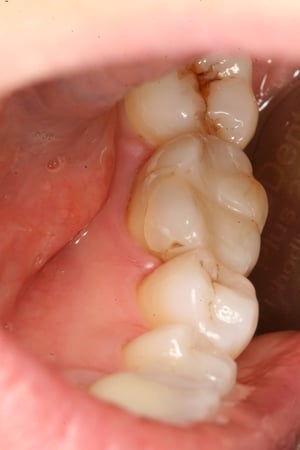 Ms L lower molar 19.9.18