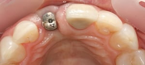 Ms W 15-8-16 implant