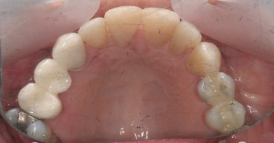 RH 10-2-22 lingual teeth