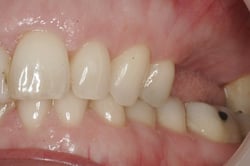 Mrs R had two missing teeth and wanted dental implants at Elmsleigh House Dental Clinic in Farnham, Surrey
