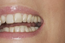 After two dental implants and retained crowns placed at Elmsleigh House Dental Clinic in Farnham, Surrey, to replace two missing back teeth
