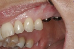 Implant placement at Elmsleigh House Dental Clinic in Farnham, Surrey