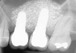 Dental implants and retained crowns at Elmsleigh House Dental Clinic in Farnham, Surrey