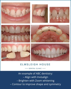 Miss B had Invisalign, teeth whitening and contouring at Elmsleigh House Dental Clinic in Farnham, Surrey