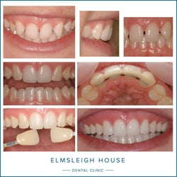 Invisalign, whitening and contouring to enhance Miss B's smile; Elmsleigh House Dental Clinic in Farnham, Surrey