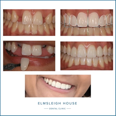 Before and after Invisalign treatment to create space for two dental implants to replace two congenitally missing incisor teeth. Elmsleigh House Dental Clinic in Farnham, Surrey