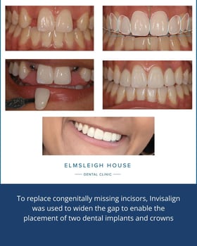 Invisalign and dental implants to replace missing teeth at Elmsleigh House Dental Clinic in Farnham, Surrey