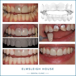 Invisalign, veneers and cosmetic dentistry at Elmsleigh House Dental Clinic in Farnham, Surrey