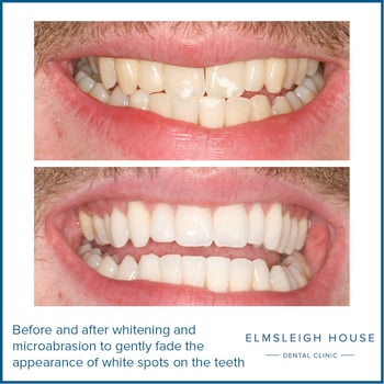 Mr C teeth whitening