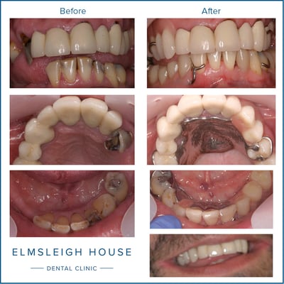 New dentures by Professor Bill Sharpling restored Mr K's smile