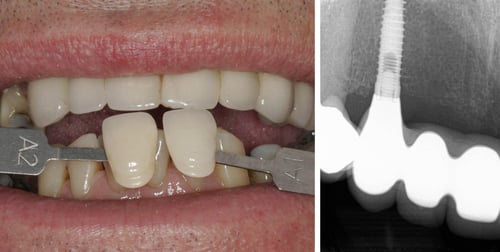 Mr K's five-tooth implant bridge was made to match the colour of his natural teeth
