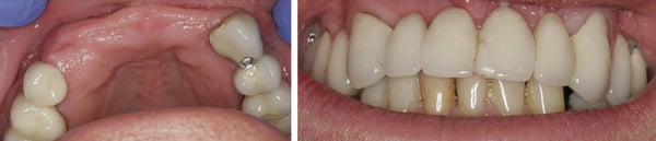 Before placing two dental implants supporting a 5-tooth bridge at Elmsleigh House Dental Clinic in Farnham, Surrey