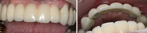 Five-tooth dental implant bridge supported by two dental implants placed at Elmsleigh House Dental Clinic in Farnham, Surrey