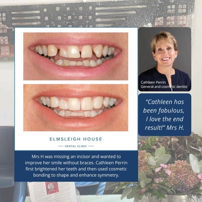 Before and after teeth whitening and cosmetic bonding by Cathleen Perrin at Elmsleigh House Dental Clinic in Farnham
