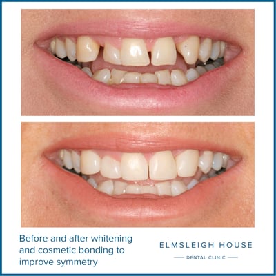 Before and after whitening and cosmetic bonding to improve symmetry; Elmsleigh House Dental Clinic in Farnham, Surrey