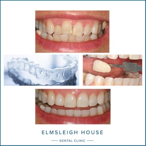 Invisalign treatment at Elmsleigh House Dental Clinic in Farnham, Surrey
