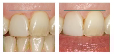 Gum lengthening surgery to restore Mrs R's smile, Elmsleigh House Dental Clinic, Farnham, Surrey
