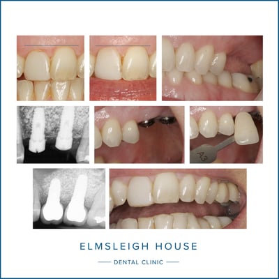 Gum lengthening and two dental implants to restore Mrs R's smile, Elmsleigh House Dental Clinic, Farnham, Surrey