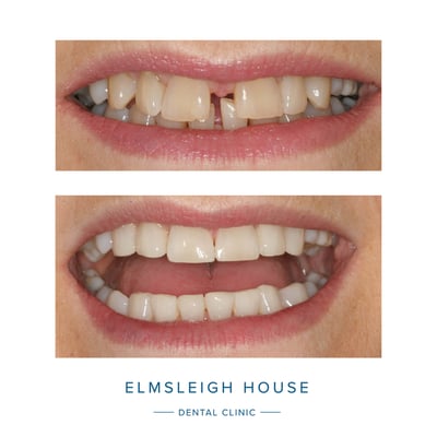 Cfast clear aligners, whitening and cosmetic bonding at Elmsleigh House Dental Clinic in Farnham