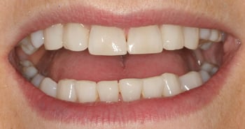 Mrs W had Cfast clear aligners, whitening and cosmetic bonding at Elmsleigh House Dental Clinic in Farnham