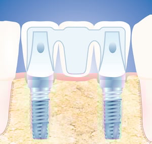 Dental implants at Elmsleigh House Dental Clinic in Farnham secure a three-tooth bridge