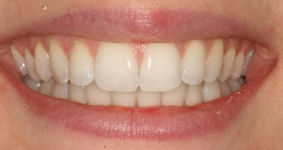 After Cfast, whitening and cosmetic bonding