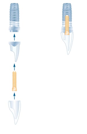 Dental implants in Farnham at Elmsleigh House Dental Clinic