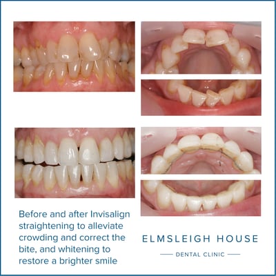Invisalign and whitening at Elmsleigh House Dental Clinic