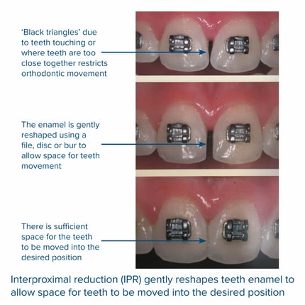 IPR brackets