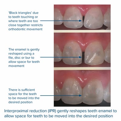 Interproximal reduction creates space during orthodonti treatment at Elmsleigh House Dental Clinic in Farnham