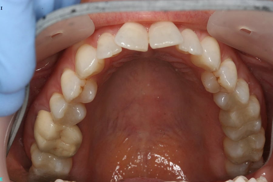 History of dental fillings