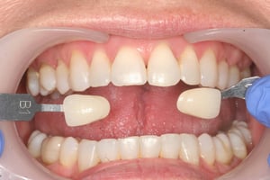 KC 19.9.20 after whitening