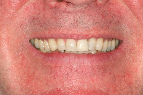 Patient after cosmetic dentistry at Elmsleigh House