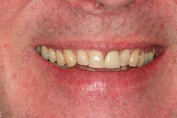Patient before cosmetic dentistry at Elmsleigh House