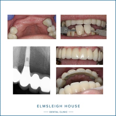 Mr K had two dental implants placed at Elmsleigh House Dental Clinic in Farnham to secure a 5-tooth bridge in place