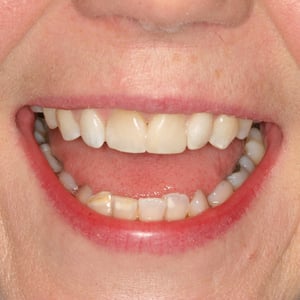 Mrs W after whitening
