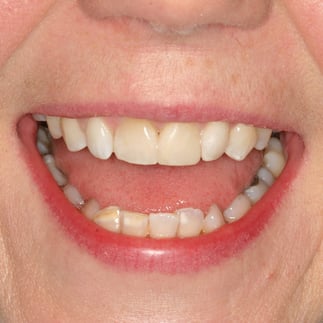 Mrs W after whitening