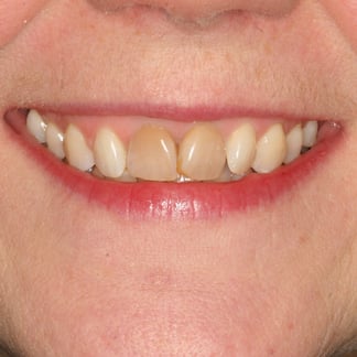 Mrs W before whitening