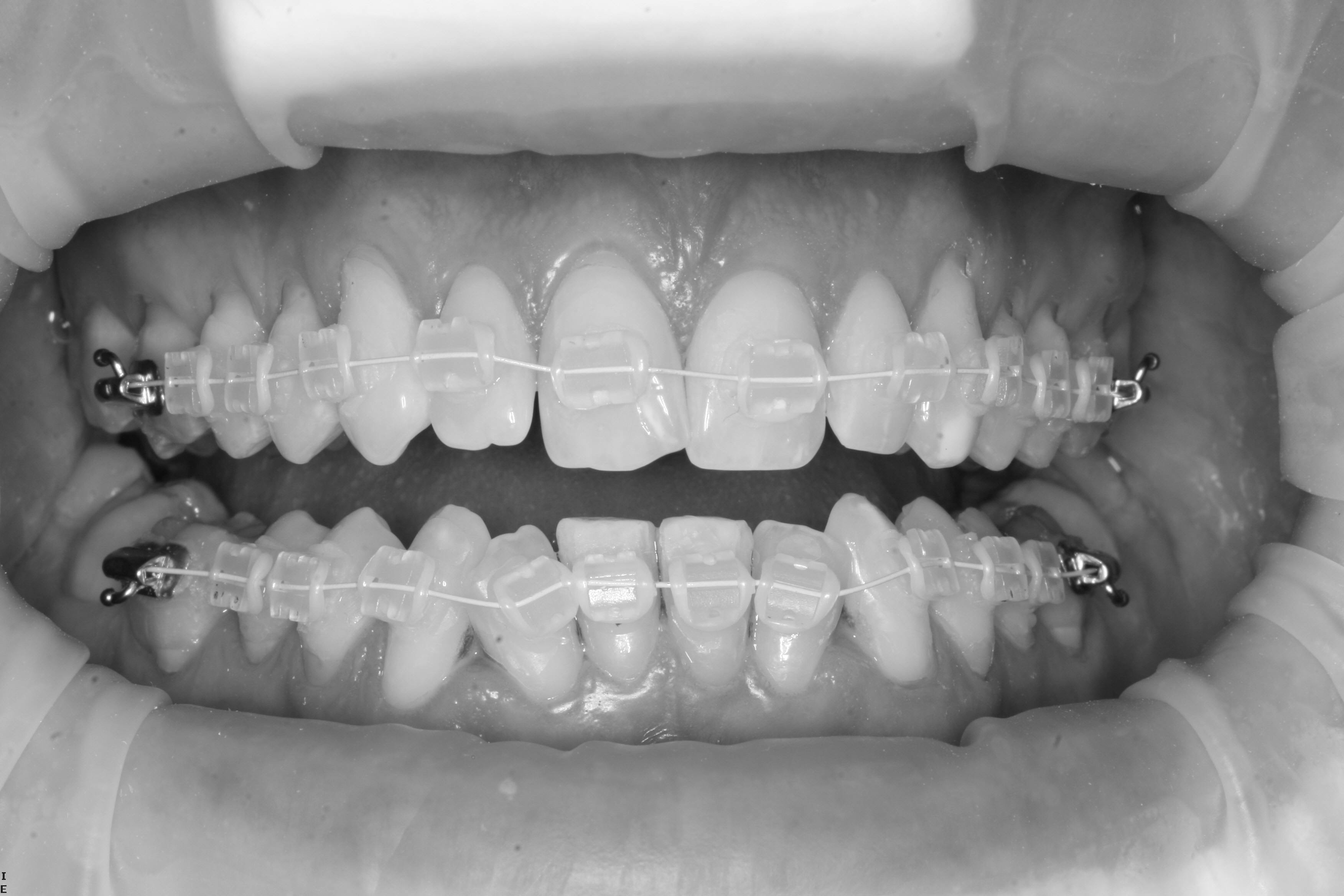 cfast teeth straightening