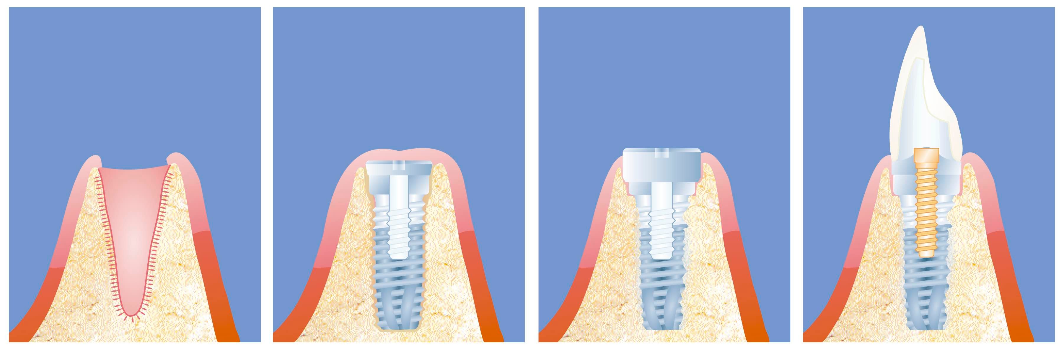 Stages of placing a dental implant to replace a missing tooth at Elmsleigh House Dental Clinic